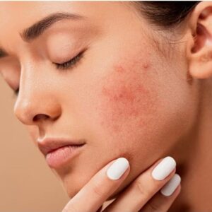 MASTER PARA PROFESIONALES DE ACNÉ Y ROSÁCEA